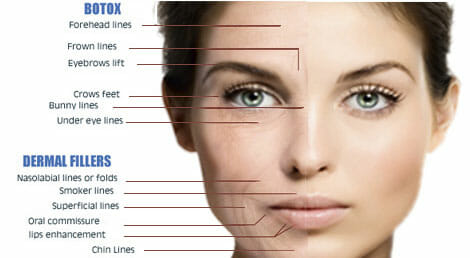 Botox in Parker, CO and Denver areas
